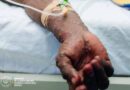 RDC – Kasaï: Cinq cas de M-pox confirmés à la prison centrale de Tshikapa