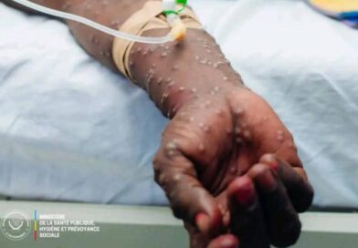 RDC – Kasaï: Cinq cas de M-pox confirmés à la prison centrale de Tshikapa