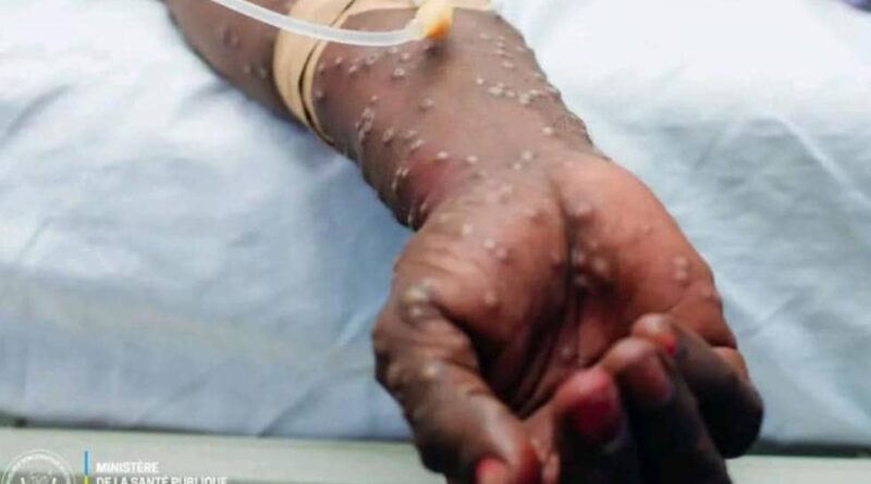 RDC – Kasaï: Cinq cas de M-pox confirmés à la prison centrale de Tshikapa